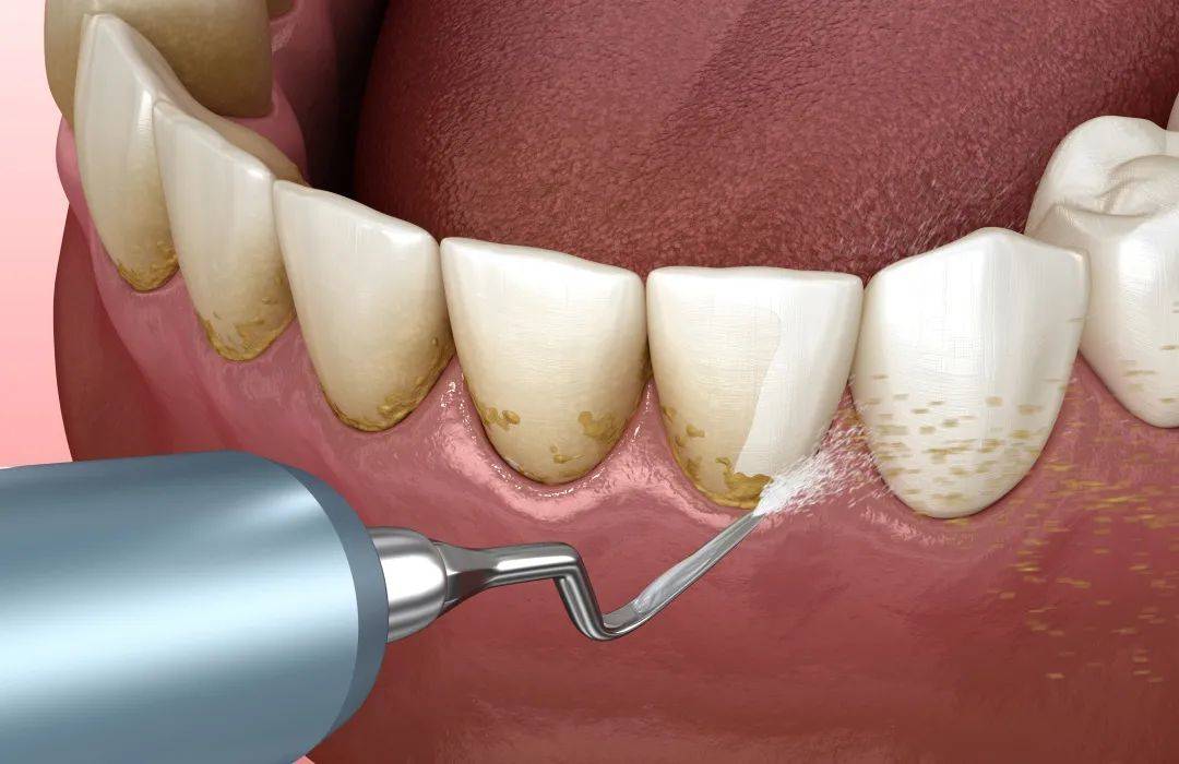 牙周冲洗:预防和治疗牙周疾病的有效方法_牙龈_其他_什么