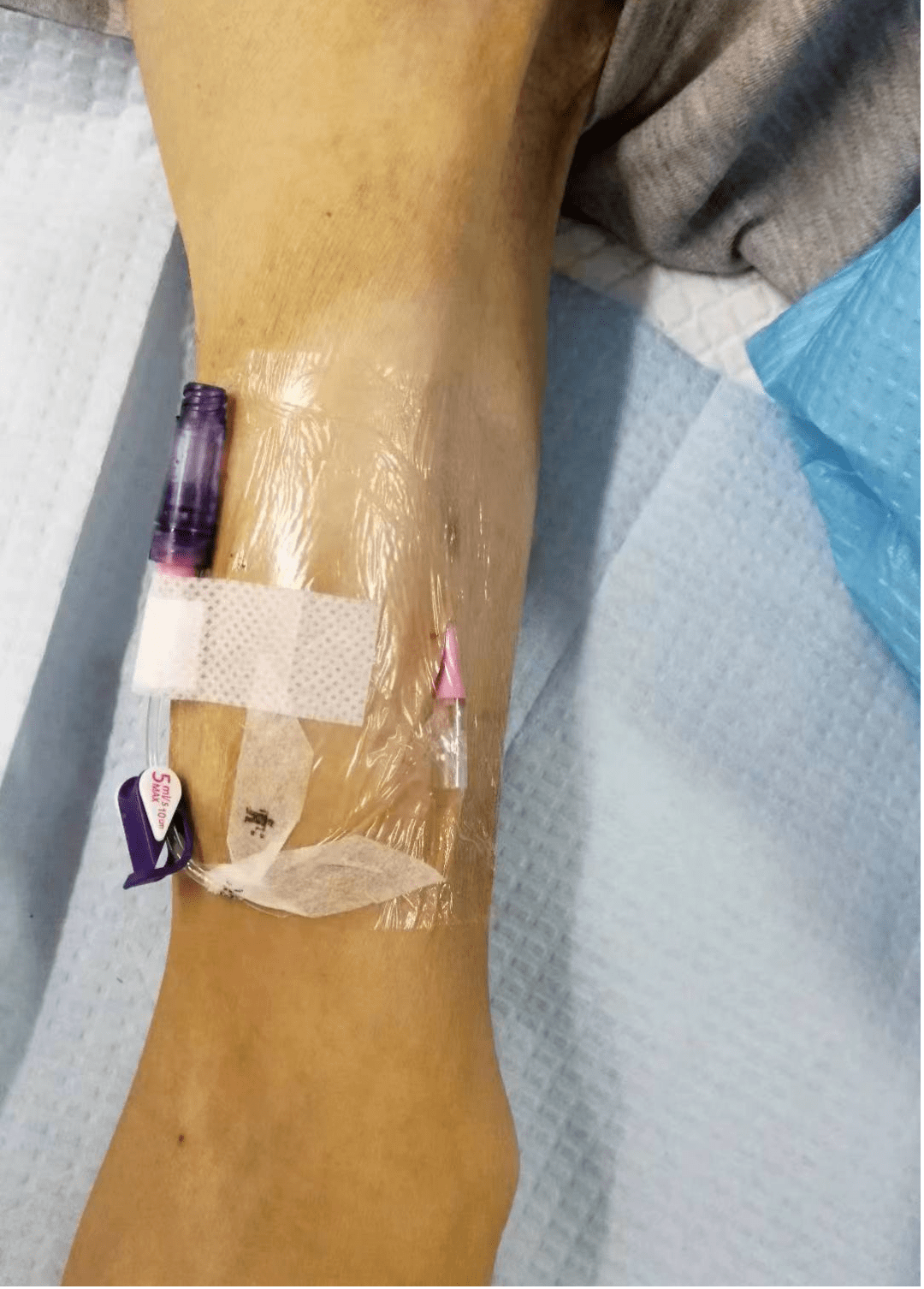 弘爱开展全省首例迷你中线导管置入_患者_静脉_治疗