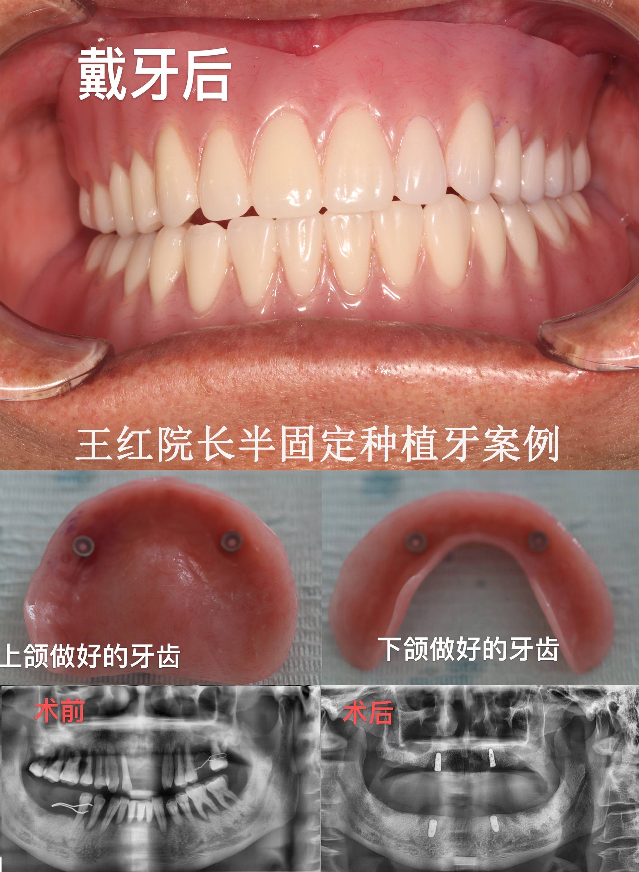 朱医生种植牙图片