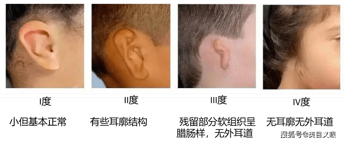 先天性小耳畸形可以戴义耳吗?_手术_耳朵_耳廓
