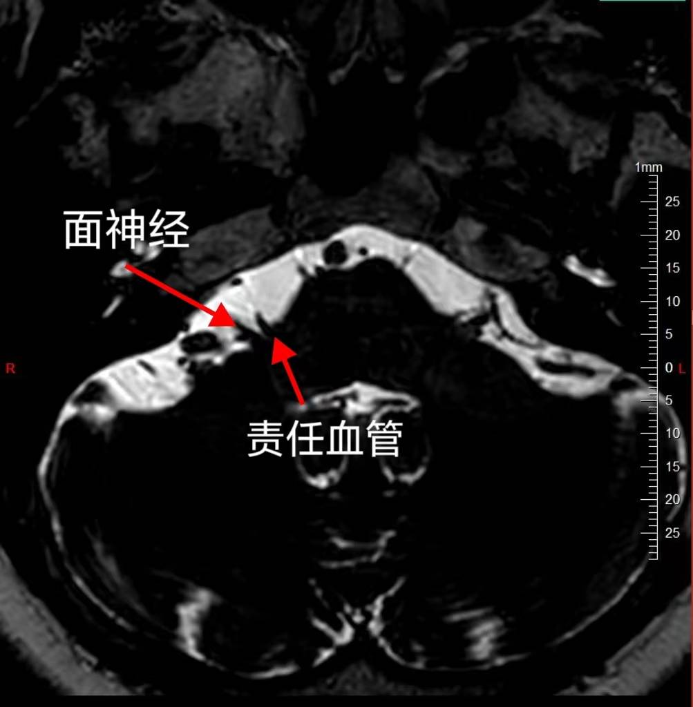 面部抽动、睡不好觉，吃药副作用太大！MVD手术让50岁的她彻底找回了“面子”-面部神经抽搐视频讲解