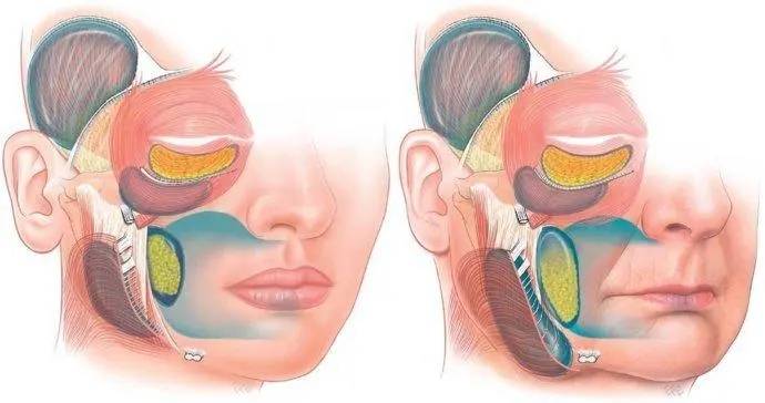 印第安纹剥离|看完这篇之前,千万不要做印第安纹剥离_博恩_过程_效果