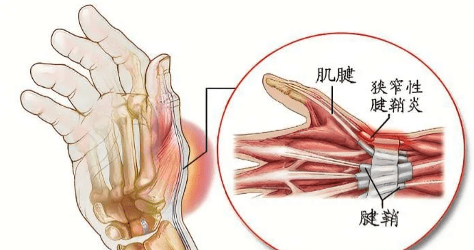 轻松治愈顽固腱鞘炎!_yao_手腕_锻炼