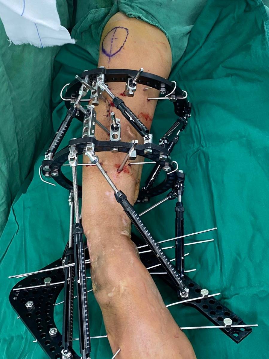 泰勒空间架和骨搬运技术成功为严重腿畸形患者保肢_产品_支架