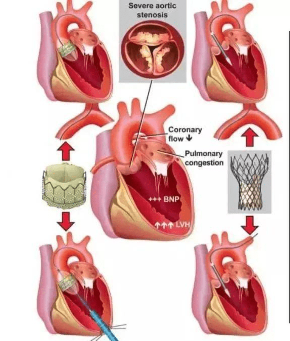 人造心瓣膜描述