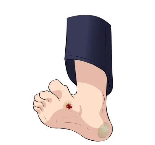 配置合适矫正鞋垫,科学干预老茧疼痛