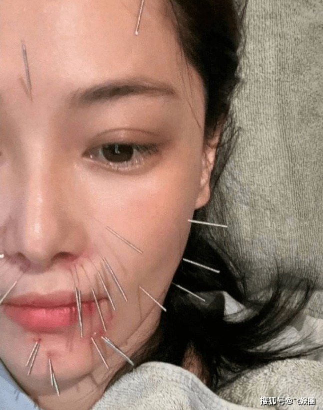 张馨予满脸扎针像刺猬,网友关心:姐姐疼吗?_美容_保养_演技