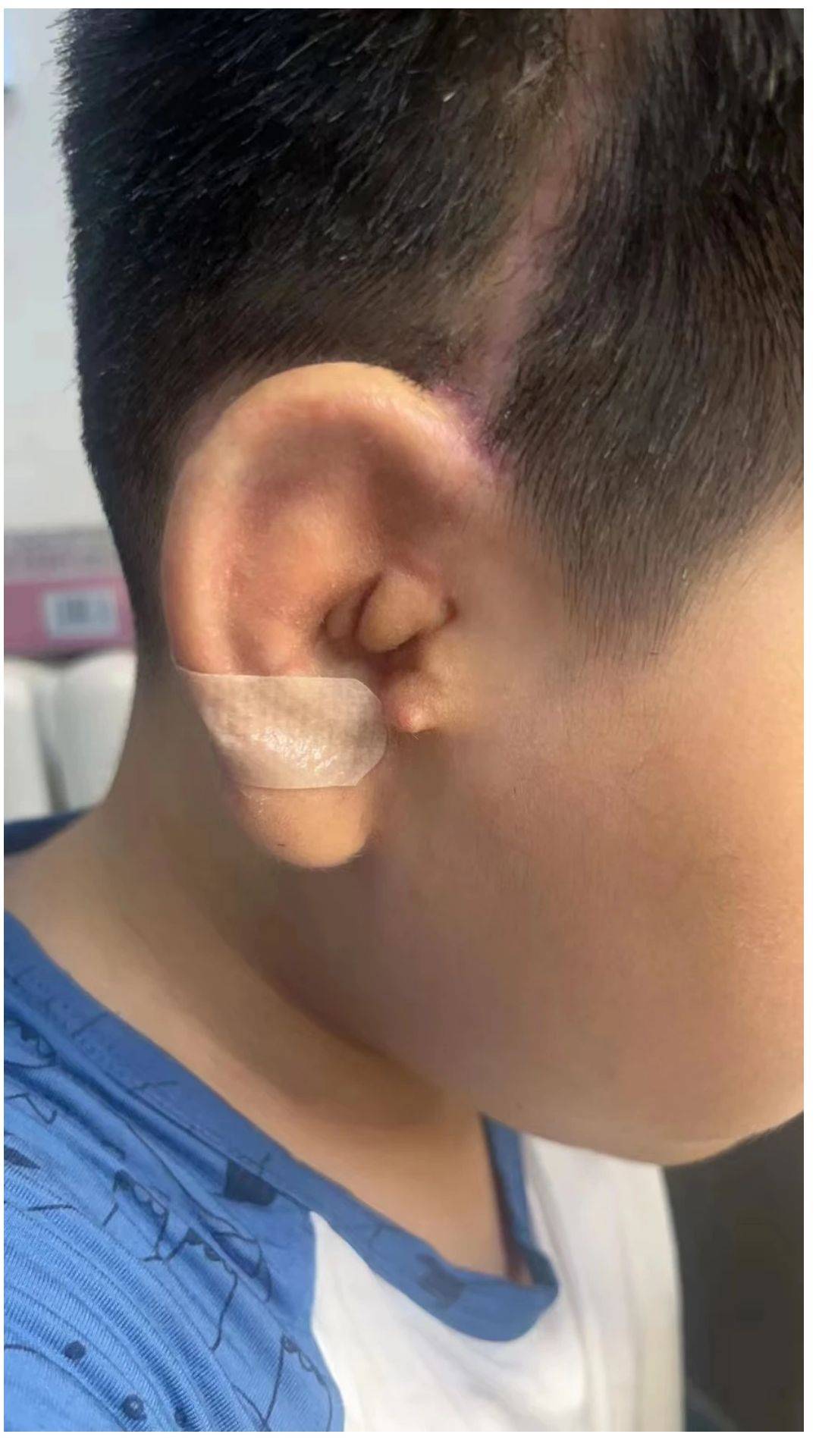 【案例分析】中年男士双侧隐耳矫正，不想耳朵留有遗憾 - 哔哩哔哩