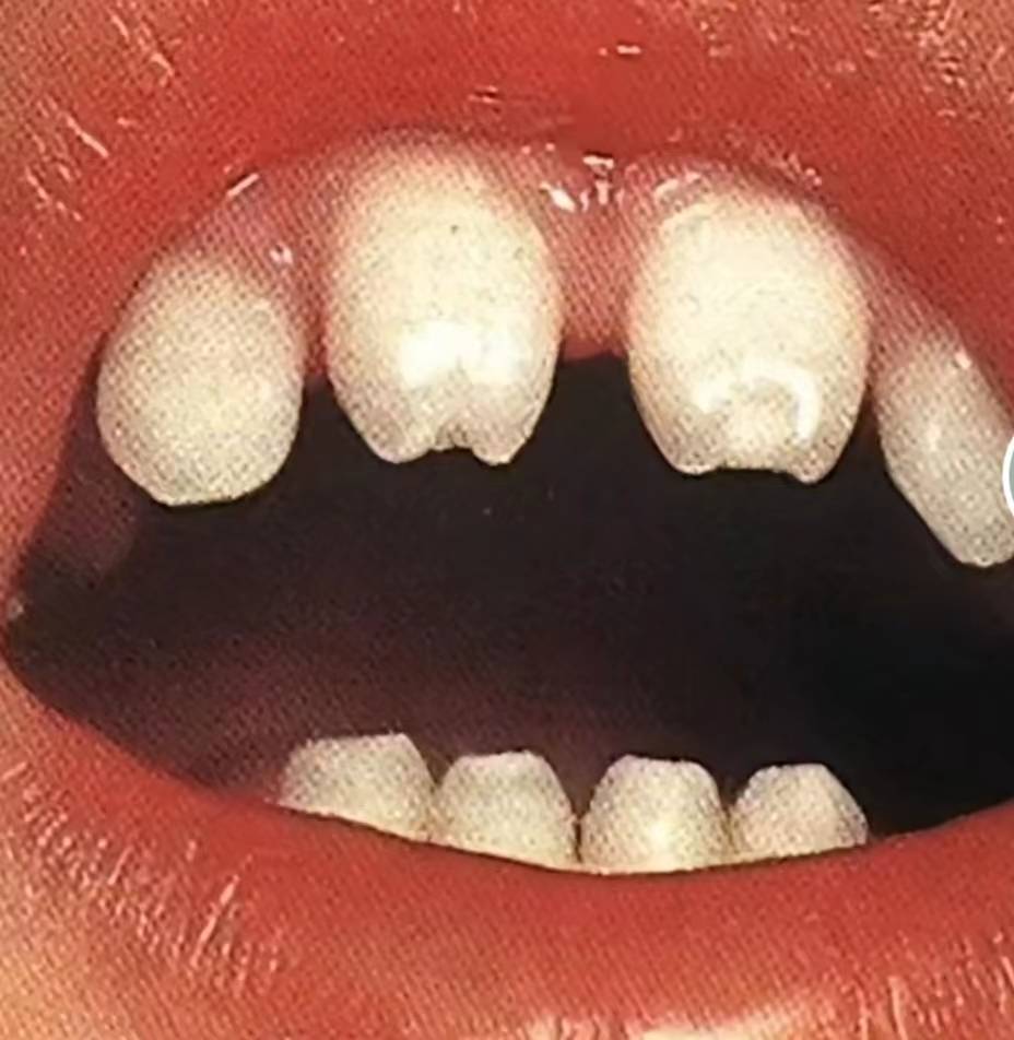 梅毒牙齿图片