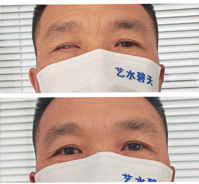 眼球摘除佩戴义眼片和保留眼球佩戴义眼两者舒适度和灵活性有区别吗