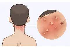 毛囊炎的危害和预防方法_头皮_严重_皮肤