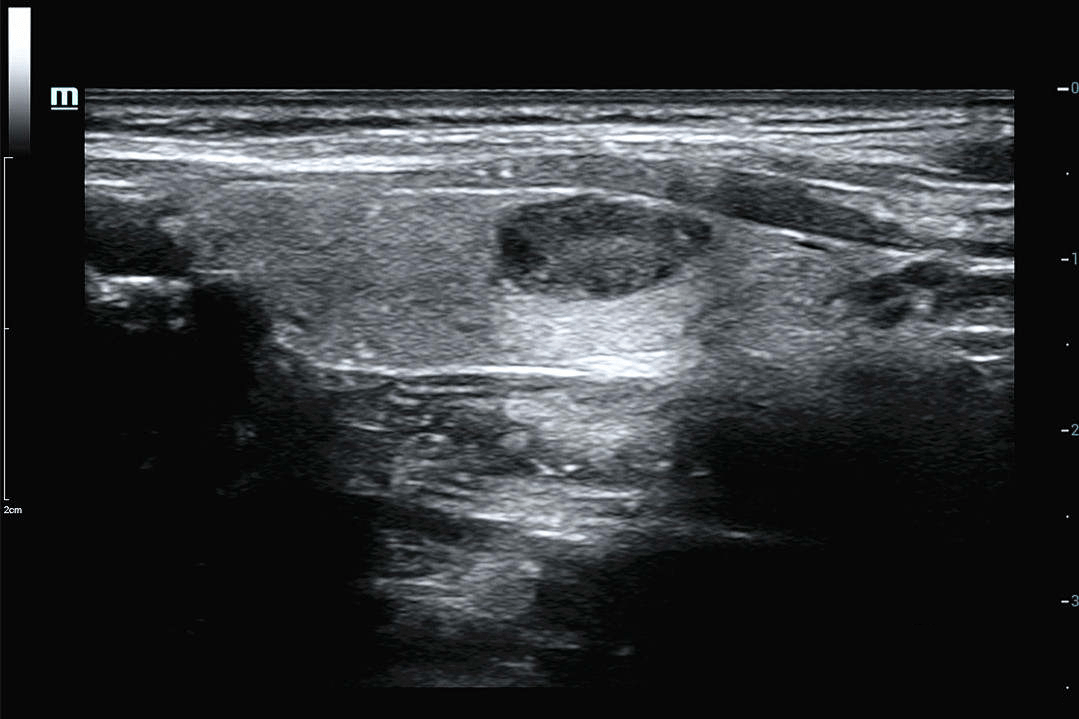 甲状腺超声的检查小知识