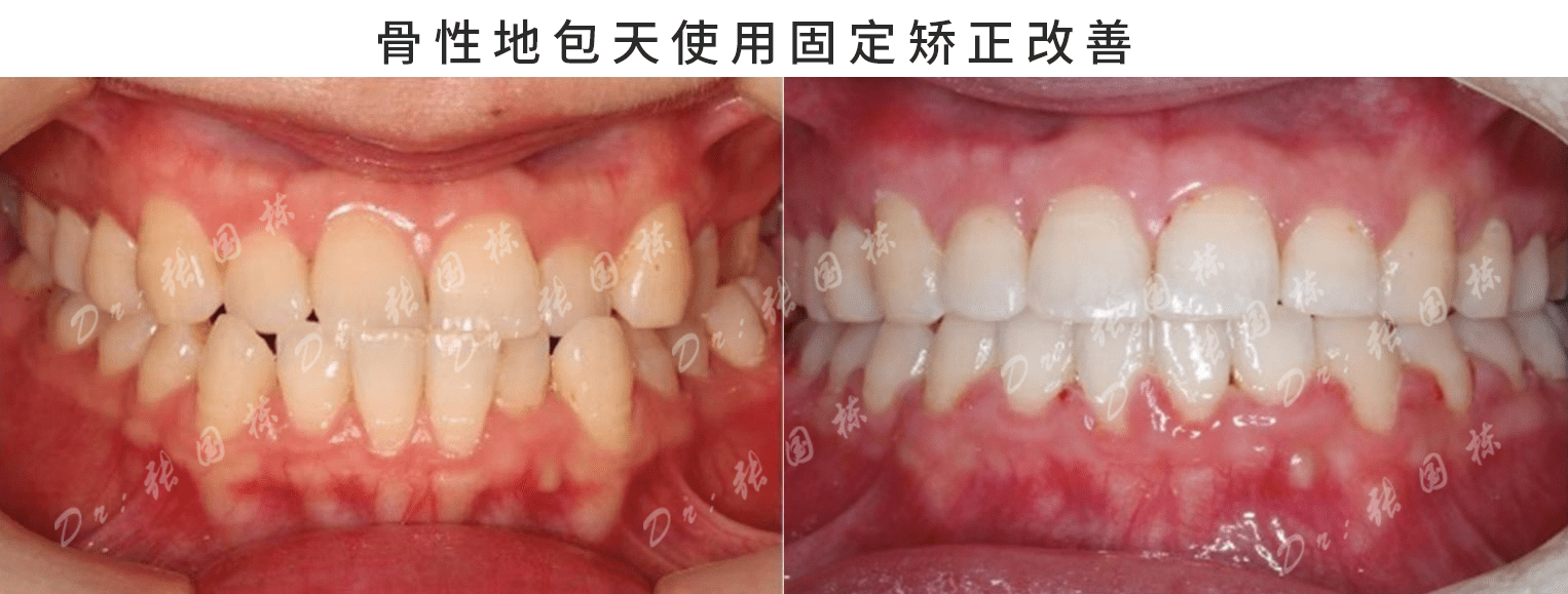 地包天一定要手術嗎?正睿齒科正畸總院長張國棟科普_影響_治療_醫生