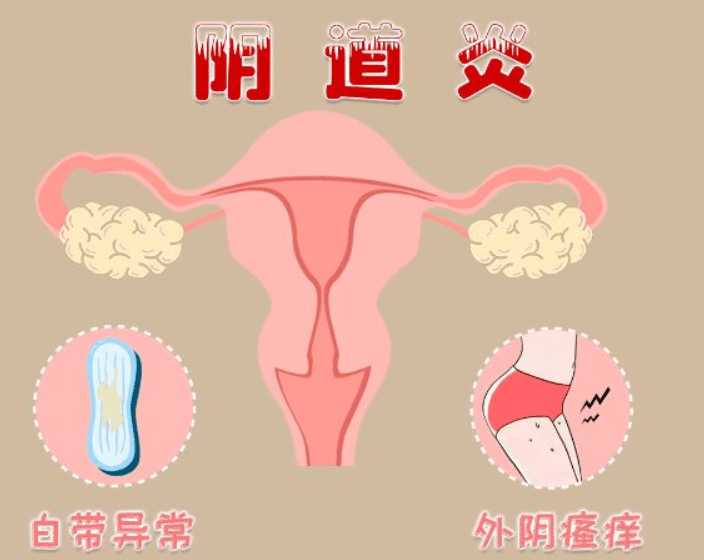 阴道炎是最常见的妇科疾病 , 请不用谈之色变_女性_霉菌性_影响