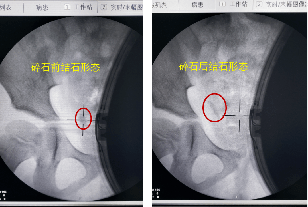 【抗击疫情 复工复产】体外碎石,3岁女孩的儿童节礼物!