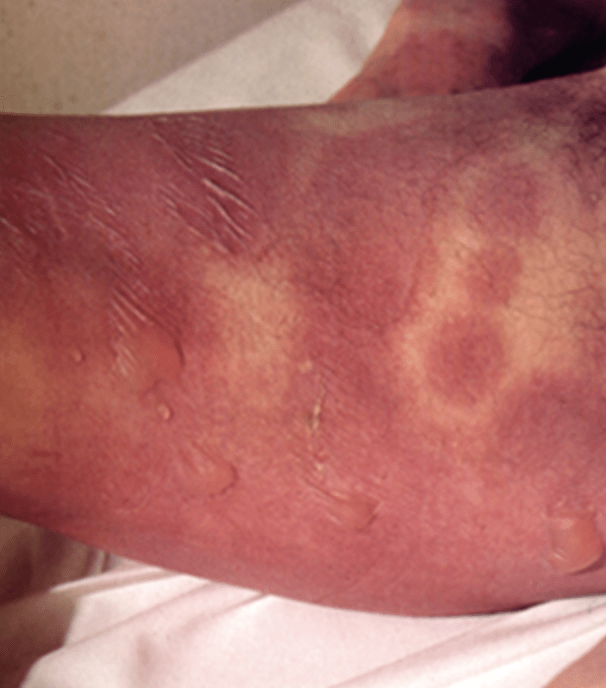 不看后悔的少见病例肺炎支原体感染居然还有这种并发症