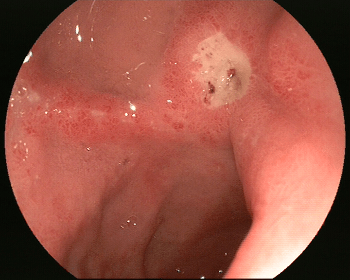胃镜十二指肠溃疡图片图片