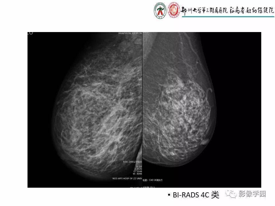 非哺乳期乳腺炎性病變與炎性乳癌影像診斷