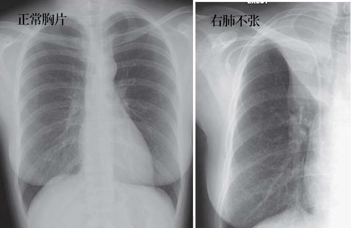 肺不张:影像基本思路