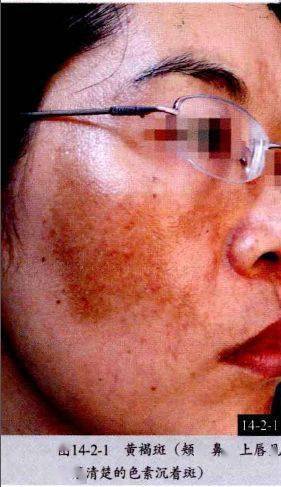 鱼鳞病68毛发角化病69汗孔角化症70掌跖角化病71原发性皮肤淀粉样变性