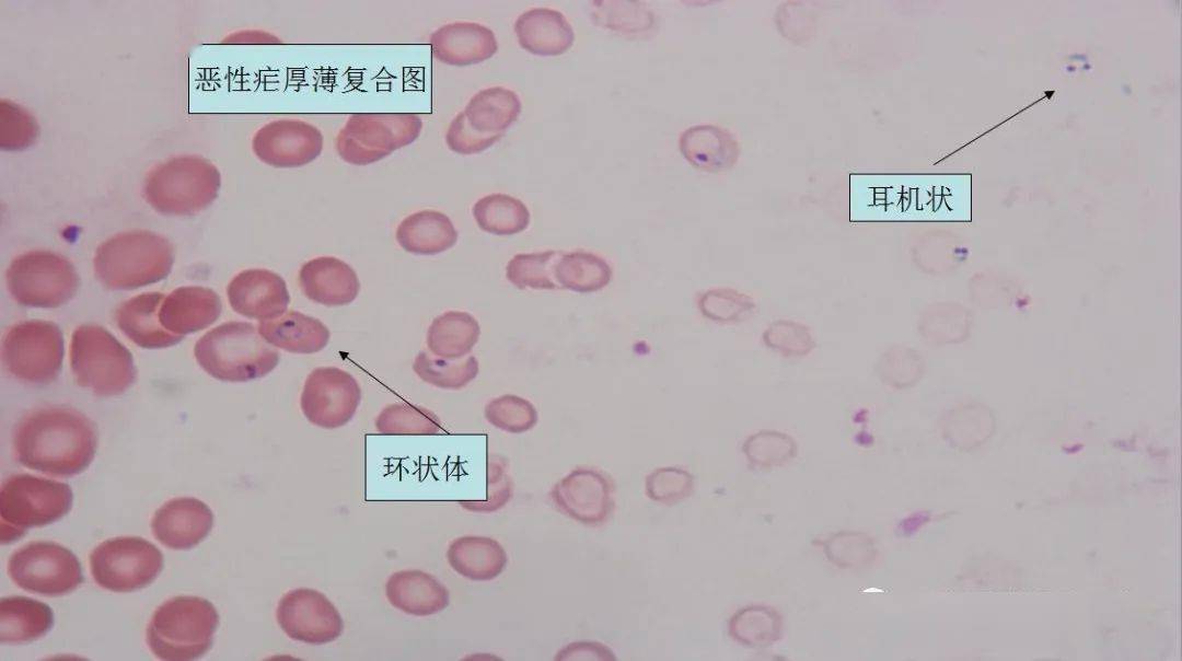 b3 例 p.f.3 例 p.o.疟原虫种类分类:9 例国人非洲归来.