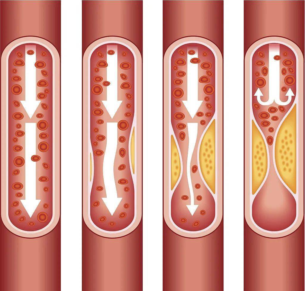 压力大,心情差,精神压力也能引起血管收缩,加速血管老化,使血管变硬.