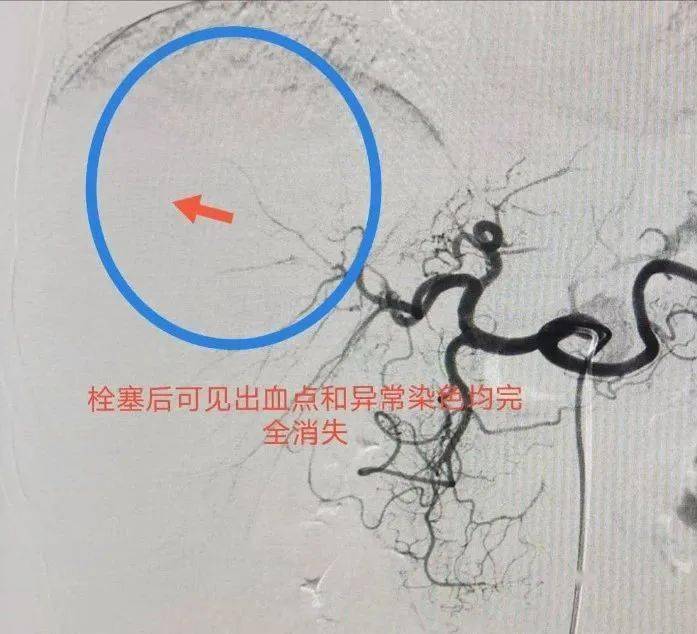 行走在血管中的止血队长泰安市中医医院介入科微导管
