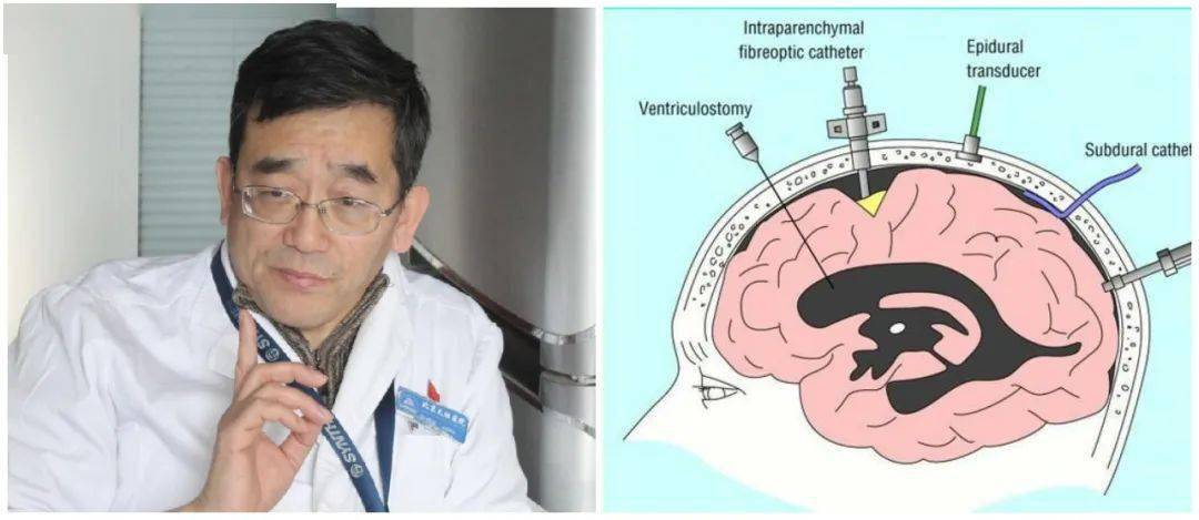 北科专栏| 专访天坛医院刘佰运: 有创颅内压监测仍是颅脑损伤主要监测