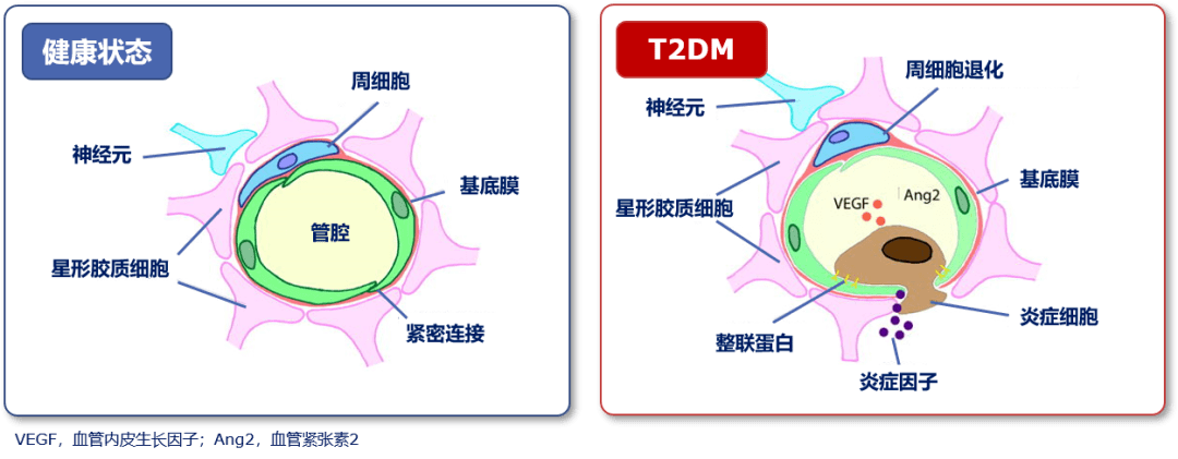 糖尿病学术前沿2型糖尿病的脑微循环并发症