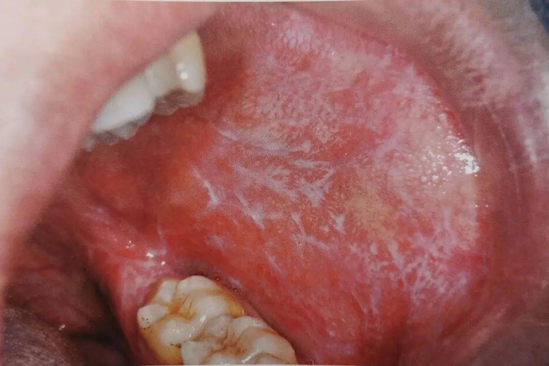 反复口腔溃疡真要命,嘉兴首个口腔粘膜病专科解您困扰_黏膜