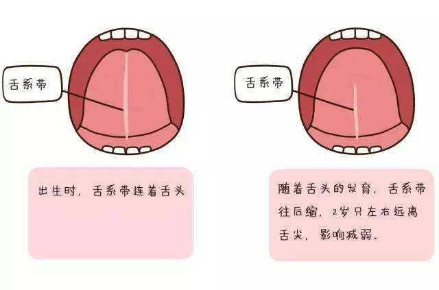 正常的舌系带能使舌头灵活地伸出口外,并能舔到人中穴位处或上卷舔到