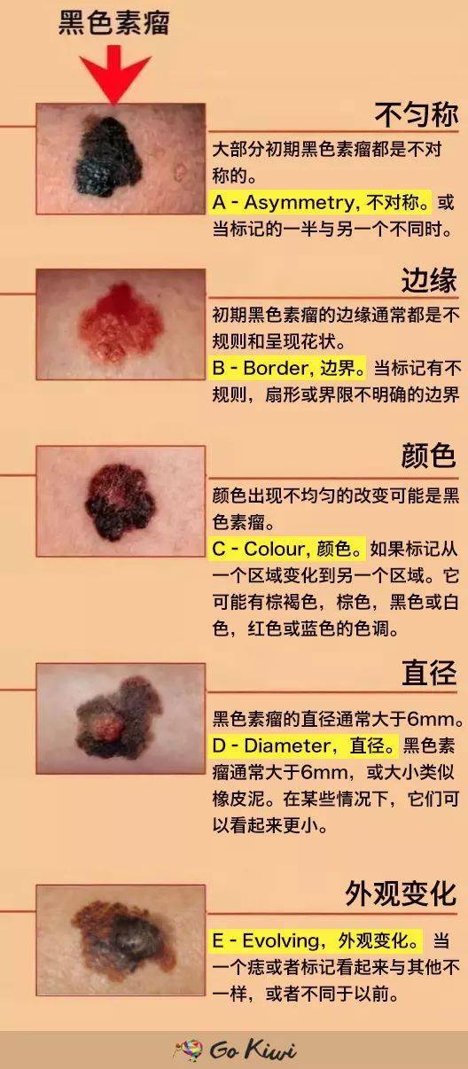 黑色素瘤死亡过程图片