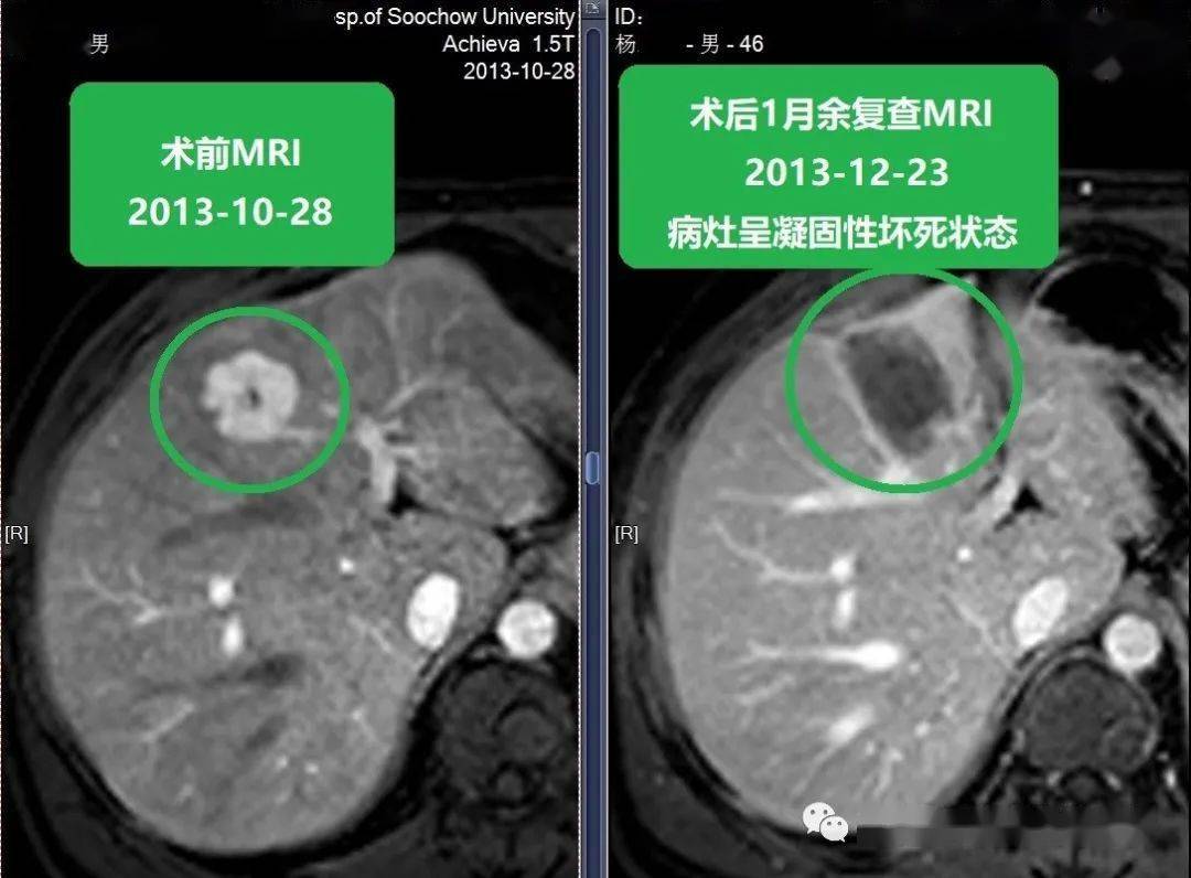 蘇大附二院靳勇醫生團隊病例分享第80期肝癌的介入消融治療