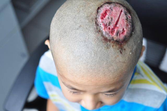 须癣毛癣菌头皮感染