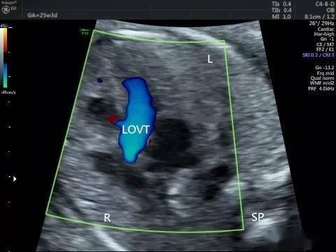 胎儿下腔静脉缺如