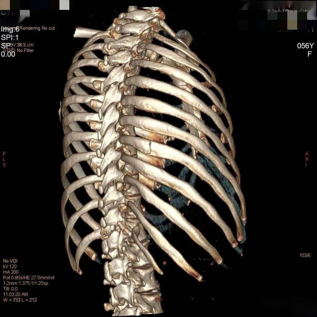 为什么肋骨骨折ct扫描一定要做三维成像