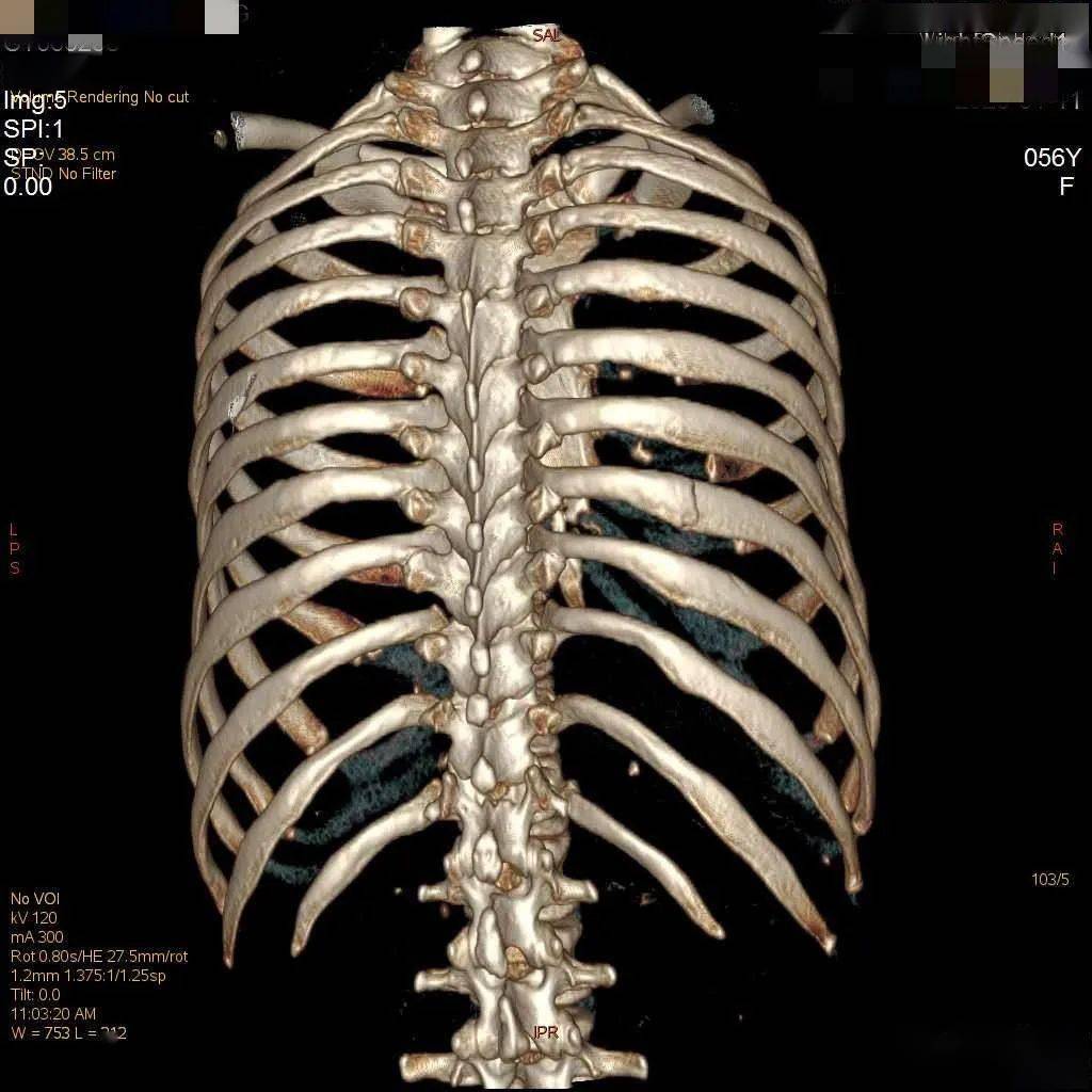 为什么肋骨骨折ct扫描一定要做三维成像