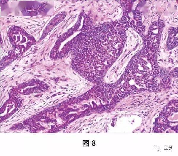 每日一例110045女性乳腺腺病