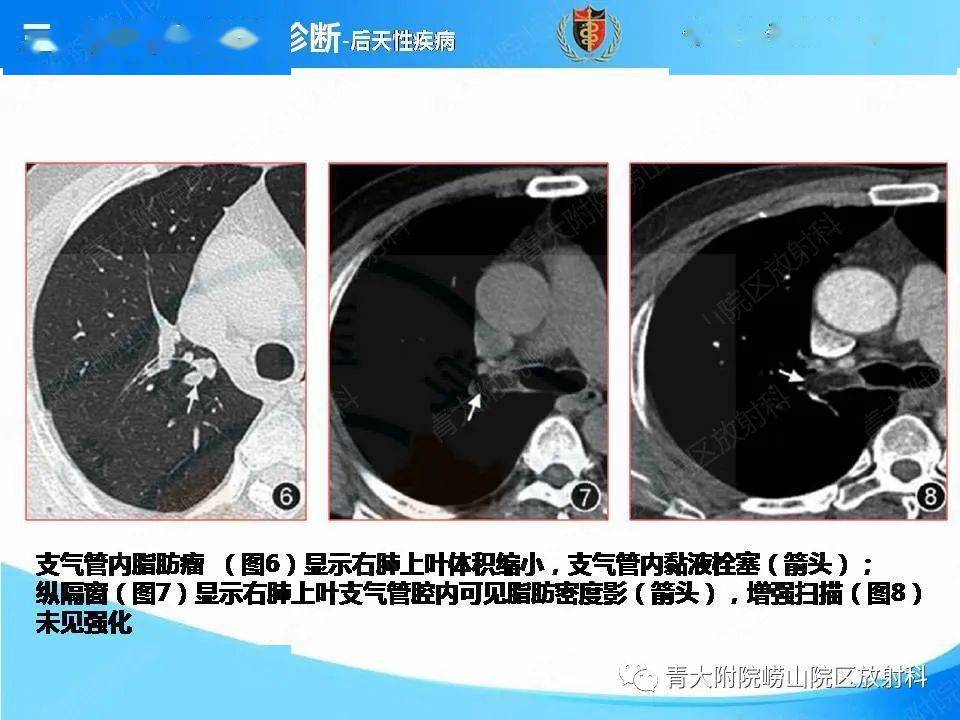 气管内粘液栓图片