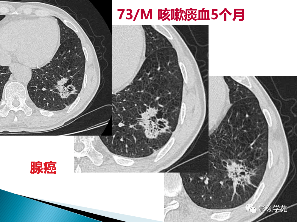 肺泡癌影像诊断与鉴别诊断