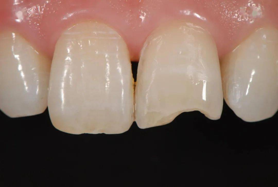 微创瓷贴面粘接剂的选择vitique瓷贴面粘接剂的临床应用体验