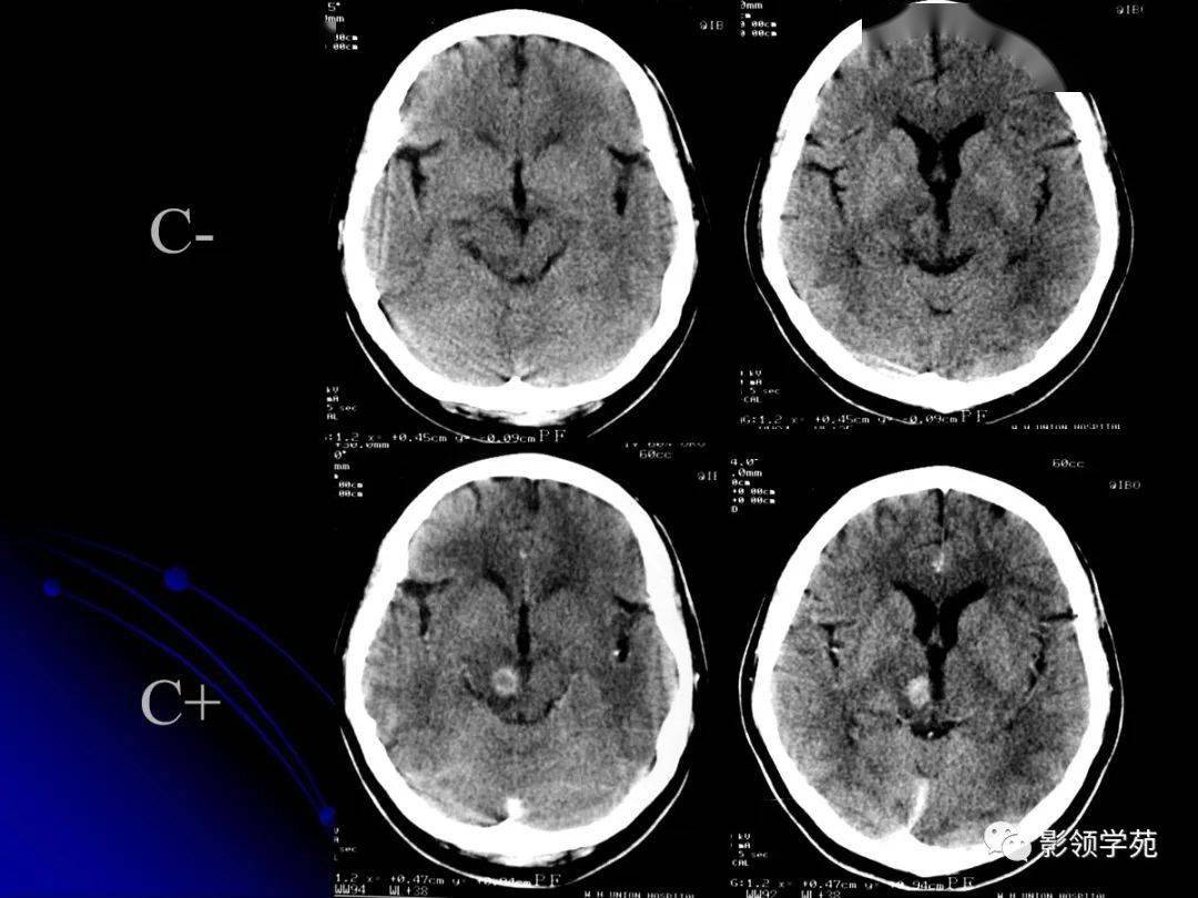 脑干区常见病变影像表现
