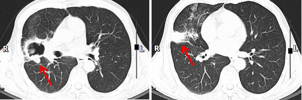 肺鳞癌晚期图片