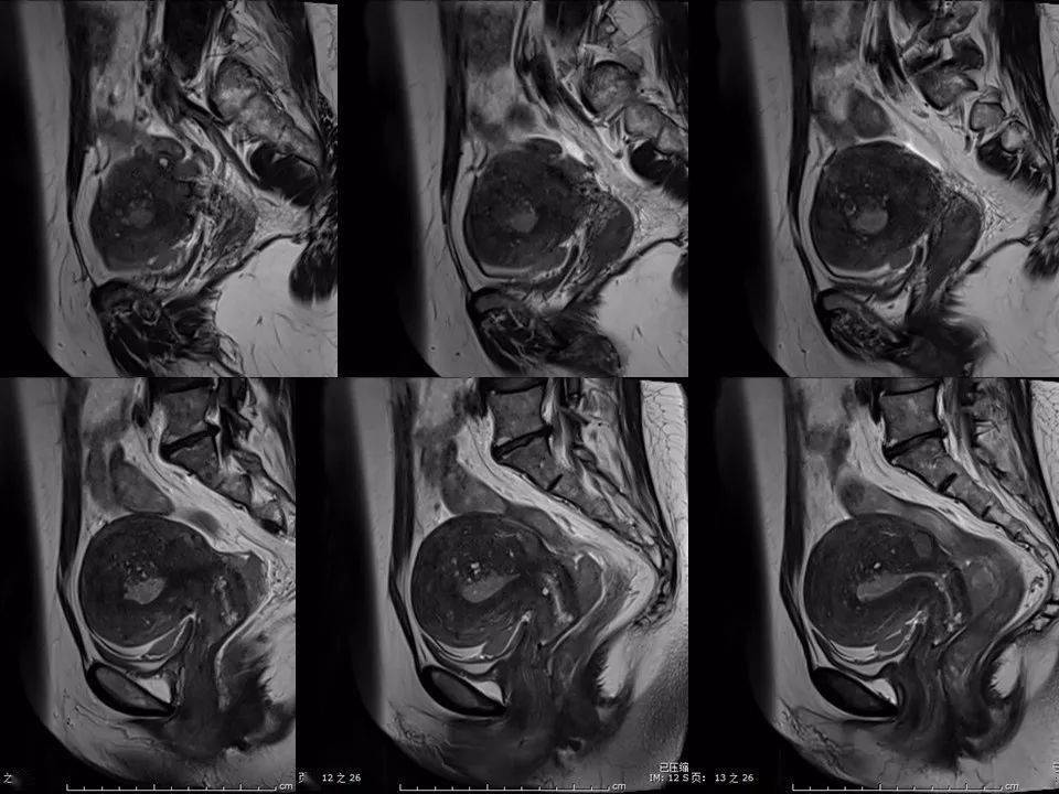 子宫常见肿瘤的mri表现