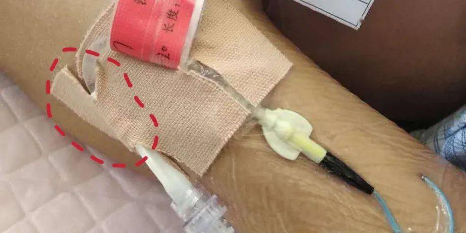 picc这样固定,太安全了!_导管