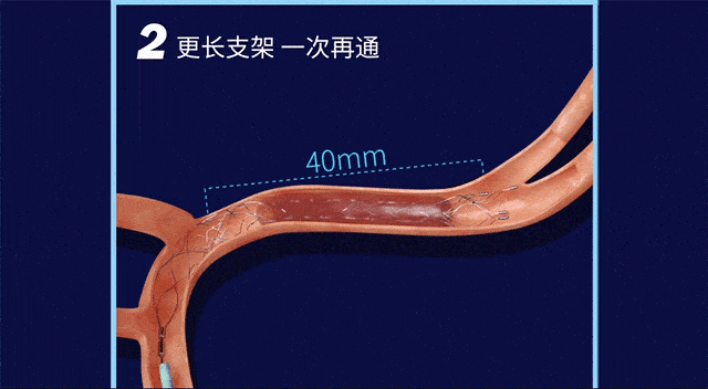 急性基底动脉闭塞重重险境 swim技术完美应对后循环血栓_支架