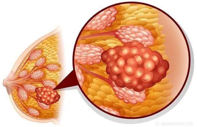 乳腺有腫塊擔心乳腺癌?這4種常見腫塊要分清