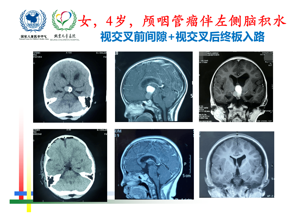 解剖課件 | 兒童鞍區腫瘤常見手術入路- 北京兒童醫院葛明