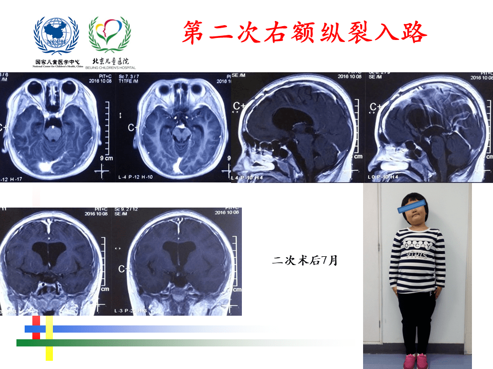 解剖课件 儿童鞍区肿瘤常见手术入路 北京儿童医院葛明