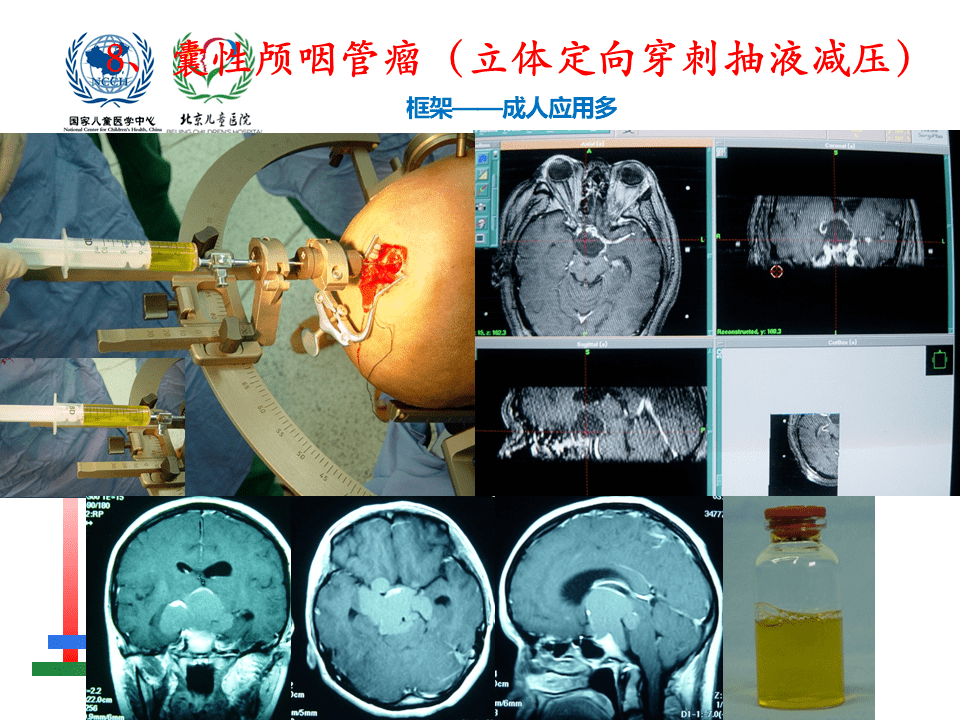 解剖课件 儿童鞍区肿瘤常见手术入路 北京儿童医院葛明